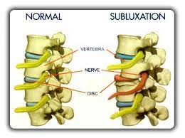 Low Back Pain Subluxation Conditions